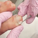 What Does Ingrown Toenail Removal Actually Look Like? ingrown toenail removal near me treatments