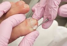 What Does Ingrown Toenail Removal Actually Look Like? ingrown toenail removal near me treatments